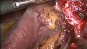 Laparoscopic partial nephrectomy (off clamp)