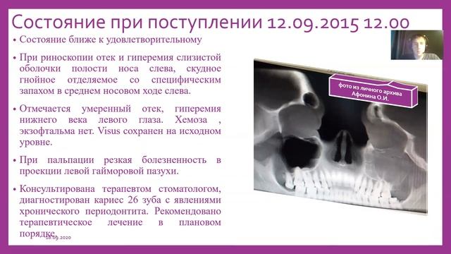 КЛИНИЧЕСКИЙ СЛУЧАЙ ДЛИТЕЛЬНО ПРОТЕКАЮЩЕГО ОДОНТОГЕННОГО ГАЙМОРИТА смотреть онлайн