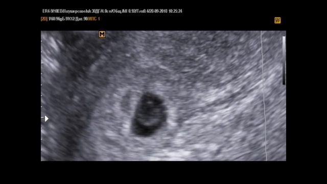 5-6 недель беременности на УЗИ - несостоявшаяся двойня смотреть онлайн