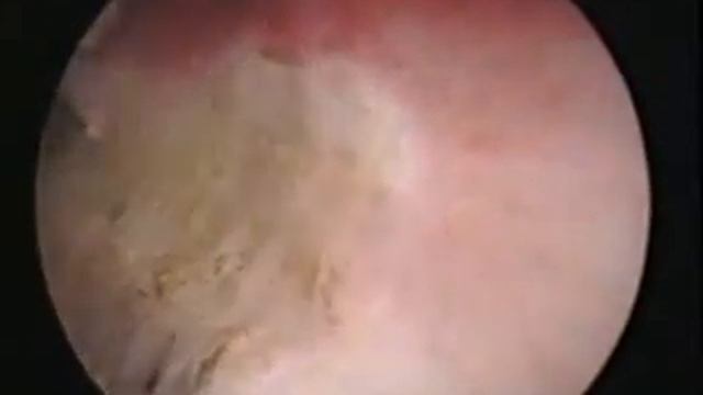 Гистерорезектоскопия. Аблация эндометрия