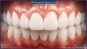 Коронки из диоксида циркония при открытом прикусе