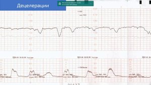 КТГ по Fisher