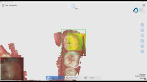 Runyes 3DS Intraoral Scanner Review - Full Arch Scanning Demonstration