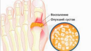 КАК ВЫВЕСТИ МОЧЕВУЮ КИСЛОТУ ИЗ ОРГАНИЗМА МАКСИМАЛЬНО БЫСТРО??
