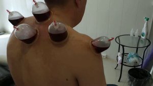Хиджама шейного остеохондроза