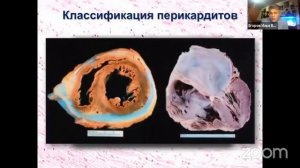 Перикардиты. Лекция профессора Егорова