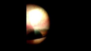 выраженная фильтрационная подушка