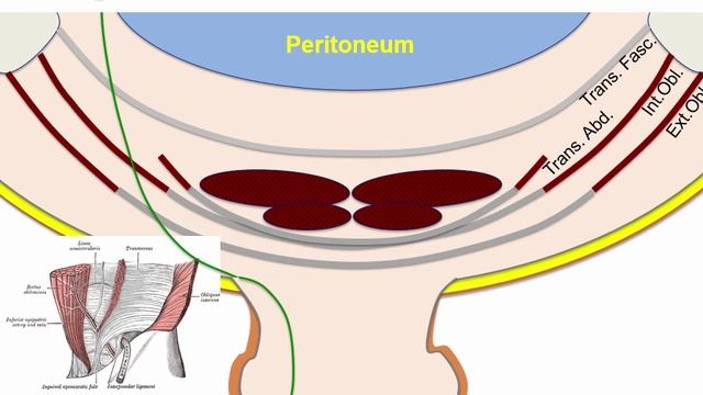 USMLE RX - 4.Желудочно-кишечный тракт - 1.Анатомия - 10.Паховый канал