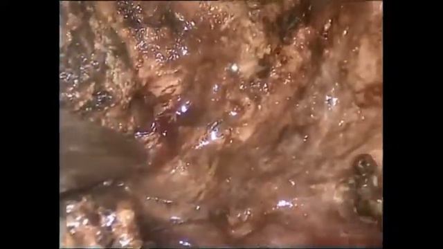 Лапароскопическая энуклеация гемангиомы печени