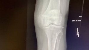 ? болит колено ? на приема у врача СНИМОК больной коленки ЛЕЧЕНИЕ НАРОДНЫМИ МЕТОДАМИ 10.12.2020