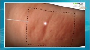 Cellulaze  лазерная липосакция