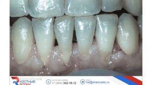 23.04.16. Мария Носова. Практикум по пластике десны. Эпизод 21