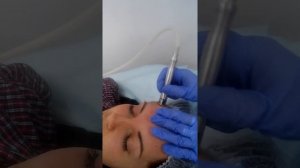 Дермабразия лица в МЦ "Оксфорд Медикал"