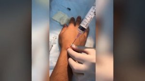 Пункционное лечение гигромы кисти в Уфе