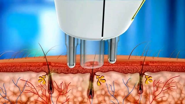 Лазерная эпиляция - современный и надежный способ удаления нежелательных волос смотреть онлайн