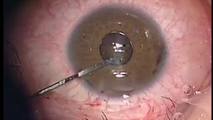 Имплантация искусственной иридохрусталиковой диафрагмы_Artificial iris-lens diaphragm implantation.