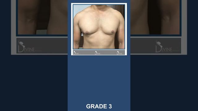 Man Breast Reduction Surgery | Grade 4 Gynecomastia