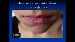 Лекция №3 для студентов 5 курса 9 семестра "Заболевания слизистой оболочки полости рта"