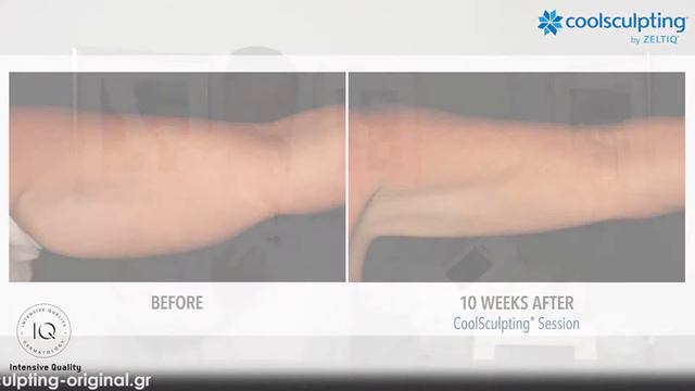 Моделирование фигуры холодом Coolsculpting на оригинальном аппарате компании Zeltiq смотреть онлайн