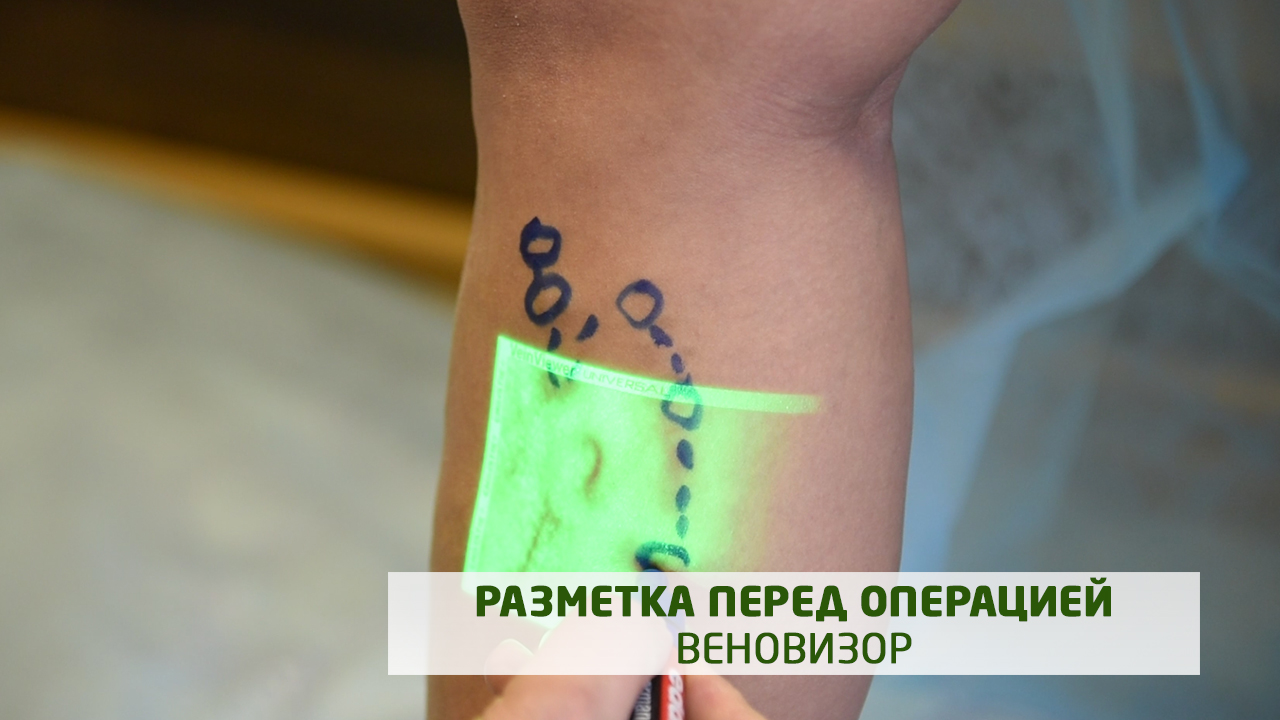 Веновизор. Разметка перед операцией