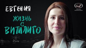 Евгения. Жизнь с витилиго. Интервью для вМесте