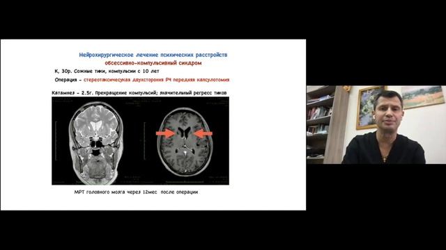 Мультидисциплинарный и политематический вебинар:последние достижения в нейрохирургии и радиохирурги смотреть онлайн