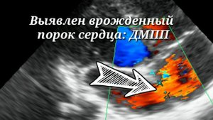 Дефект межпредсердной перегородки. ВПС: ДМПП (ASD)