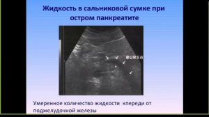 УЗИ поджелудочной железы