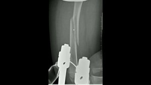 Скелетное вытяжение. Перелом бедра у ребенка лечение.