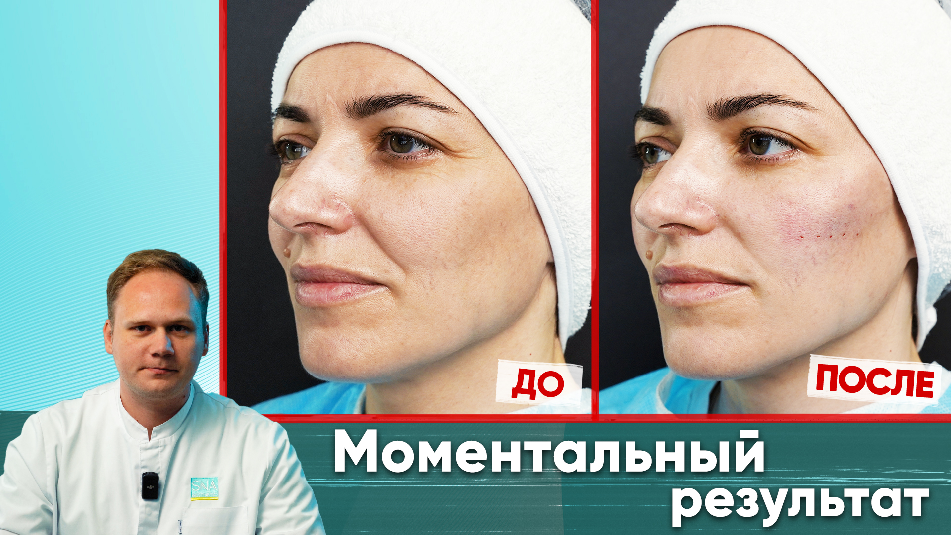 Моментальный результат после тредлифтинга