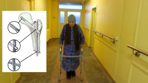 НАША РАБОТА Успех Реабилитации Перелом БЕДРЕННОЙ КОСТИ