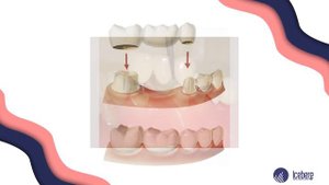 Мост или имплант, что лучше выбрать? / Имплантация зубов. Мост зубной