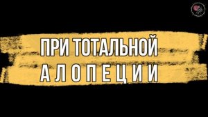 Тотальная алопеция у женщины скрыта трихопигментацией. Total alopecia vs Scalp Micropigmentation.