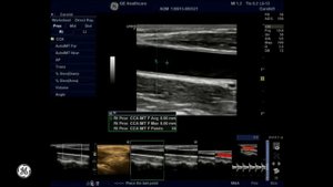 УЗИ аппарат GE LOGIQ F8