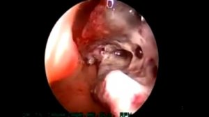 Опарыши в носу