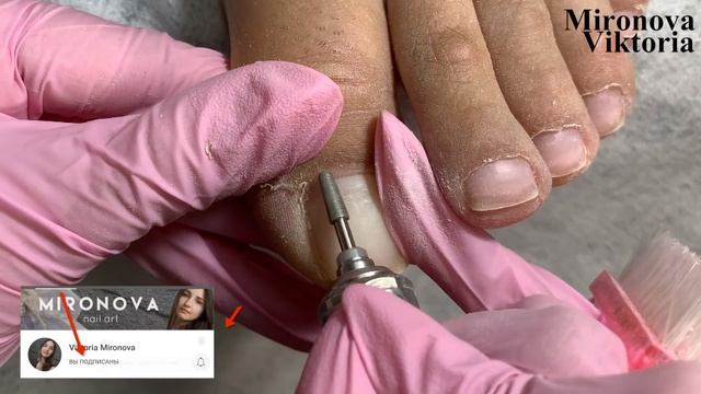 Аппаратный педикюр / Онихолизис /
