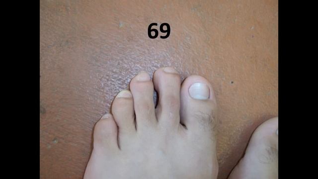 My 84 Day Lamisil Journey with 250mg pills. ( toenail fungus ) смотреть онлайн