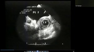 Видеолекция клиники Мэйо  Перекардиты