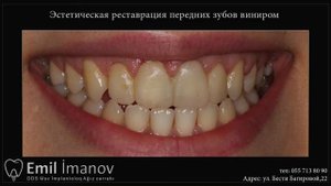 Эстетическая реставрация передних зубов виниром