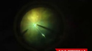 Эпиретинальная мембрана. Лечение