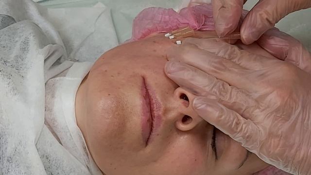 АирисКом студенты учатся: мезонити для коррекции лица. Линейные, спиральные с насечками. смотреть онлайн