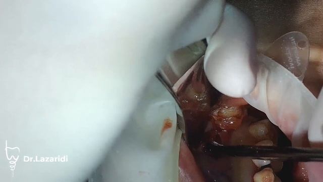УДАЛЕНИЕ РЕТЕНЦИОННОЙ КИСТЫ ИЗ ВЕРХНЕЧЕЛЮСТНОЙ (ГАЙМОРОВОЙ) ПАЗУХЕ.
