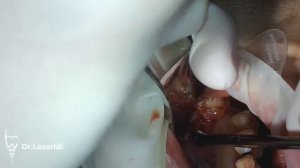 УДАЛЕНИЕ РЕТЕНЦИОННОЙ КИСТЫ ИЗ ВЕРХНЕЧЕЛЮСТНОЙ (ГАЙМОРОВОЙ) ПАЗУХЕ.