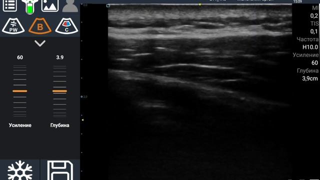 УЗИ сканер Delta 8 - Запись экрана процесса сканирования смотреть онлайн