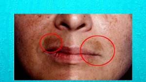 Как удалить избавиться от пигментных пятен?