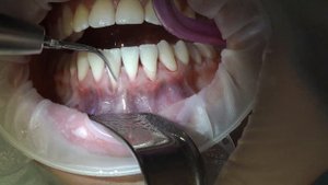 Лечение рецессии десны тоннельной техникой. Закрытие оголенного корня зуба