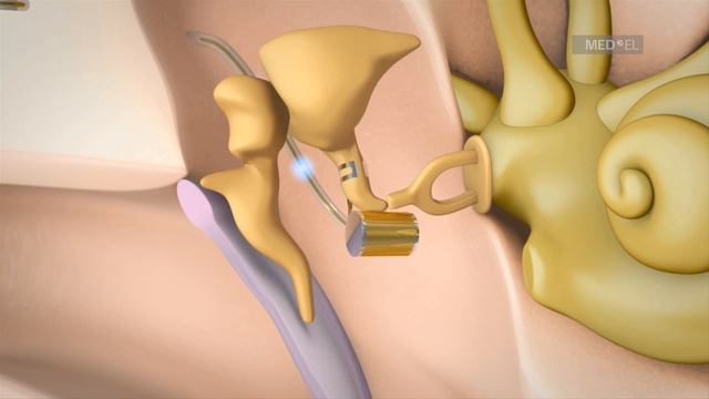 VIBRANT SOUNDBRIDGE Middle Ear Implant System for Hearing Loss Video | MED-EL USA смотреть онлайн