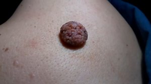 ПАПИЛЛОМАТОЗНЫЙ НЕВУС - ЛЕЧЕНИЕ. День 8