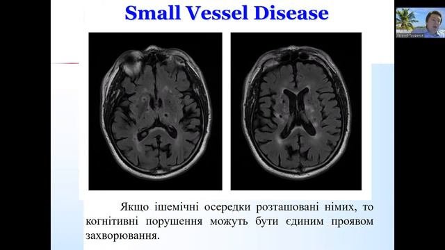 ! 2021 03  Сосудистая деменция  Без рекламы