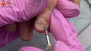 Ожог ногтевой пластины / Отрывала гель лак вместе с ногтем